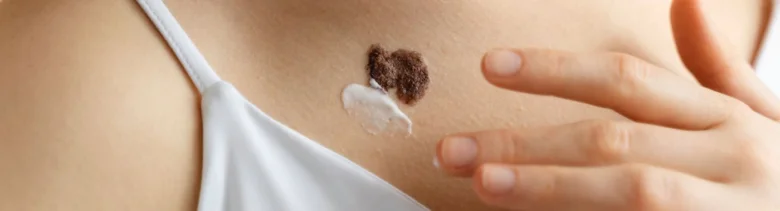 Nanosekání krému na keloidní jizvu na kůži.