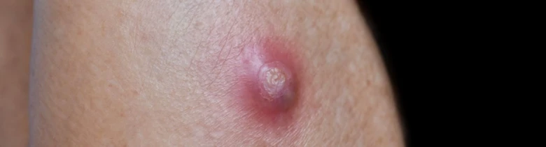 Zvětšený pohled na kožní vřed s kůrou.