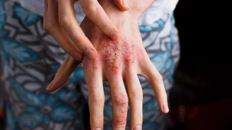 Hand with eczema rash