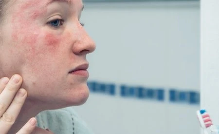 Woman with rosacea face