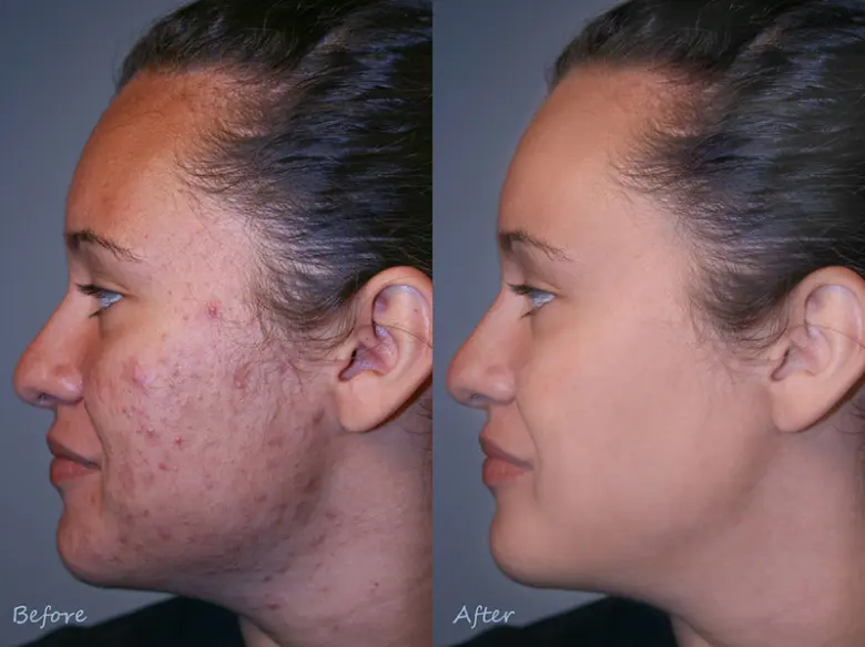 Acne before and after treatment