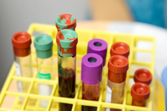 Krevní vzorky ve žlutém držáku pro laboratorní vyšetření.
