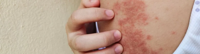 Rozšířené červené kopřivky na lidské kůži.
