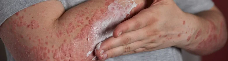 Červený vyrážkový výrvek na kůži paže s aplikací krému.