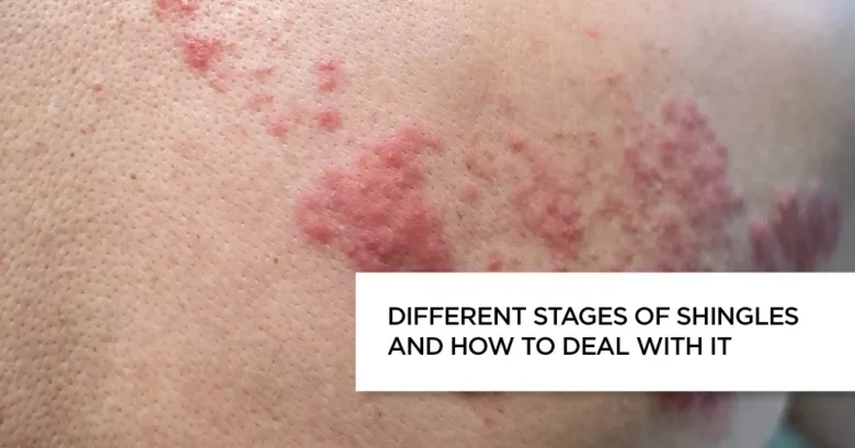 Shingles rash on skin