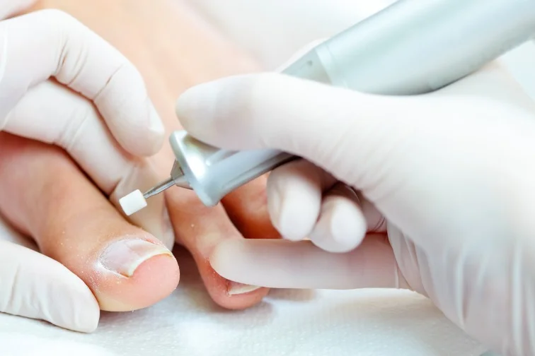 Pedicurista upravuje nehet elektrickým vrtákem při léčbě zarostlého.