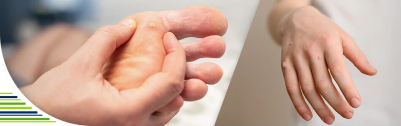Ruce s bradavicemi před a po vypalování dusíkem