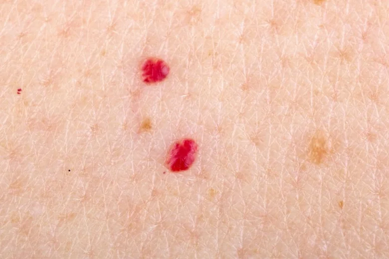 Skin hemangioma lesions