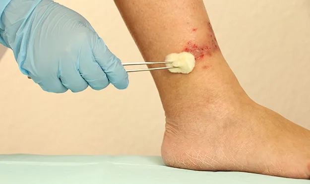 Ruka v rukavici aplikuje vatový tampon na zánětlivou ránu nohy.