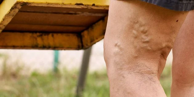 Varicose veins on leg
