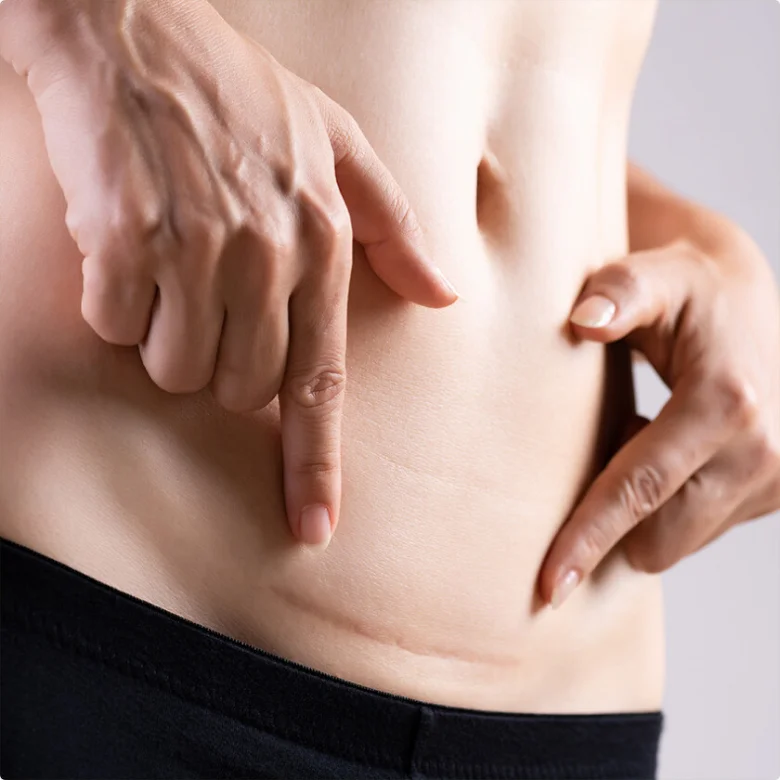Postpartum abdominal incision healing