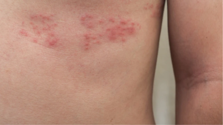 Child hives rash on skin