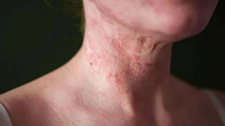 Atopic eczema rash on neck