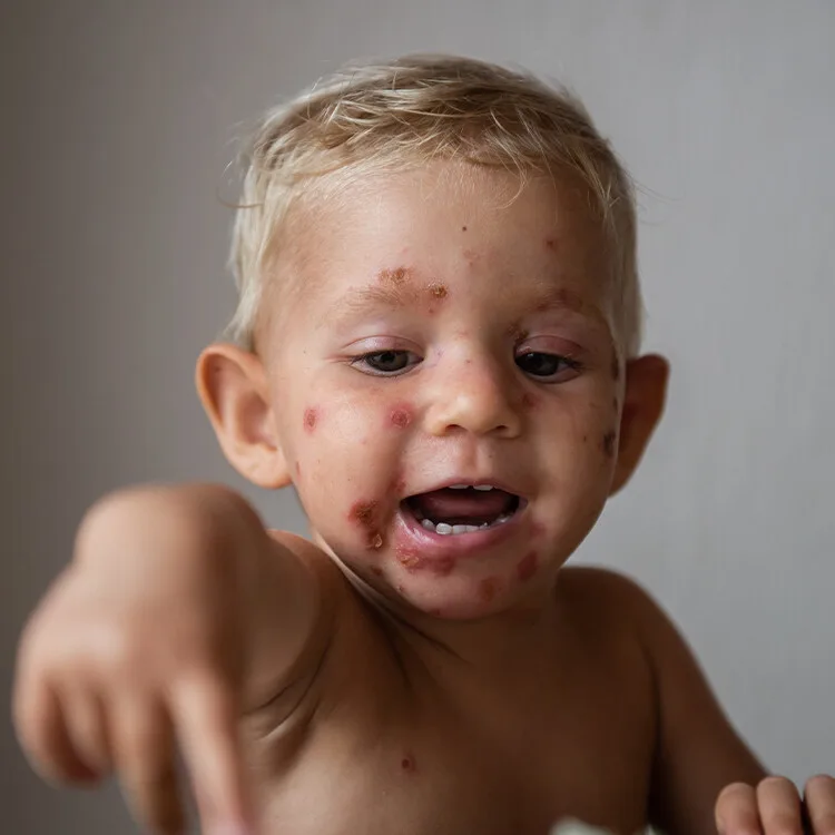 Malý dítě s typickými vředy na obličeji při onemocnění impetigem.
