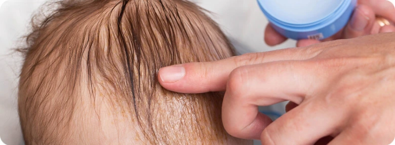 Baby scalp with cradle cap being treated