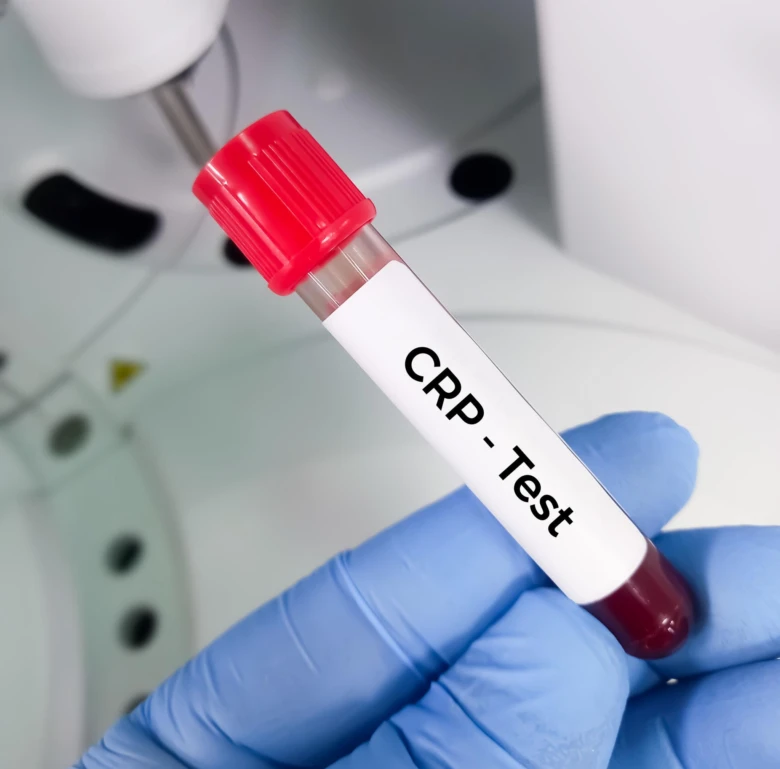 Krevní vzorek pro test CRP v laboratoři.