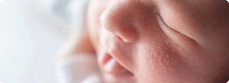 Sleeping baby with sweat rash