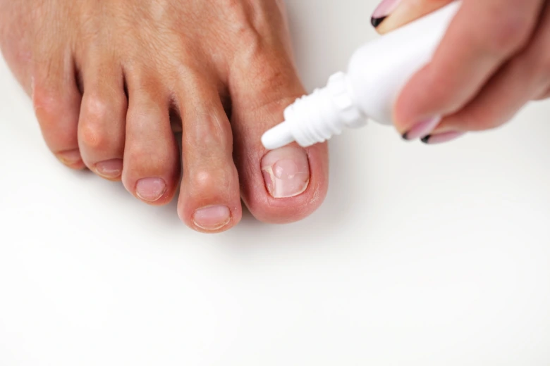 Applying nail treatment to foot