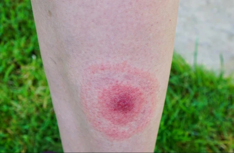 Červená vyrážka na kůži po ukousnutí klíštětem.