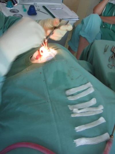 Chirurgický zákrok na nosní přepážce během operace.