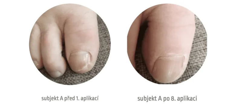 Fungal nail infection before and after treatment