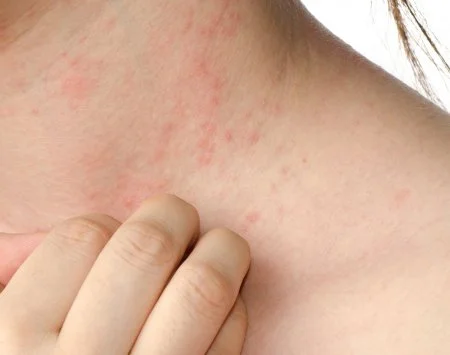 Red skin rash on neck