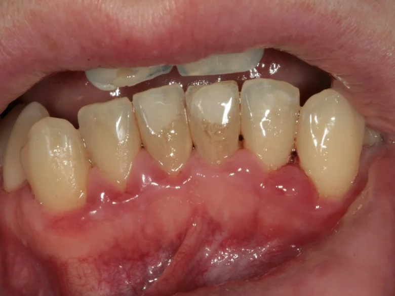 Zvětšený pohled na zánět dásní a zubní plak před hygienou.