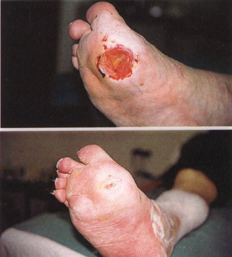 Zdravící rána na noze diabetika před a po léčbě.