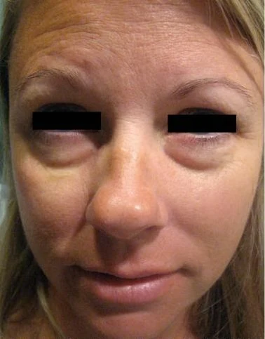 Woman with under-eye bags