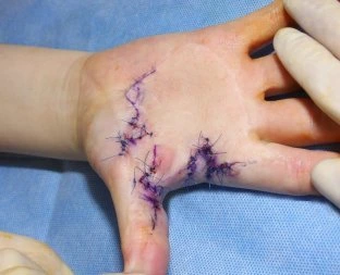 Burn wound on hand with sutures