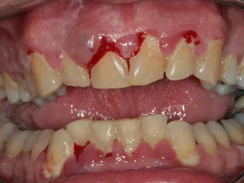 Zvětšený pohled na krvácející dásně při zubní hygieně.