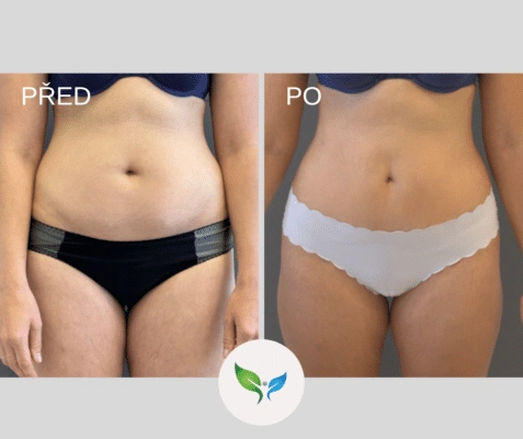 Porovnání před po operaci liposukce na břiše ženy.