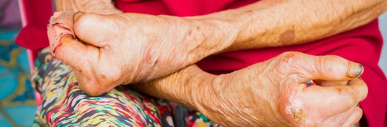 Staré ruce s příznaky malomocenství jako jsou zbarvení a poškození tkáně.