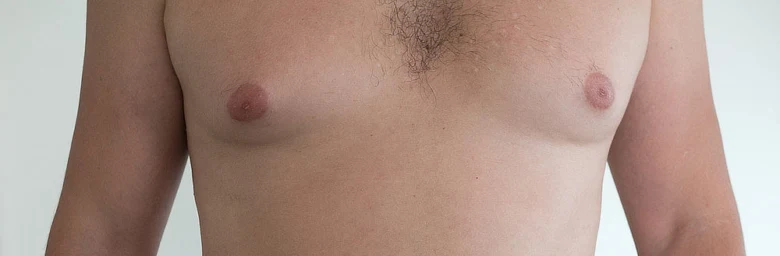 Muž s gynekomastií, zvětšené bradavky na hrudi.