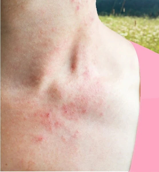 Červená vyrážka na krku způsobená alergií.