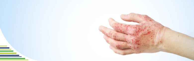Hand with eczema rash