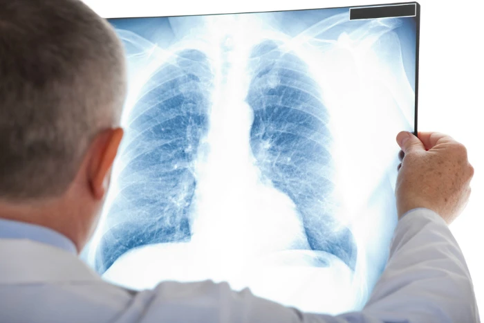 Doctor examining chest x-ray
