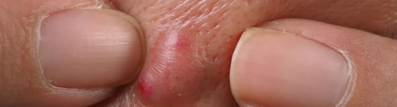 Zvětšený absces na kůži mezi prsty.