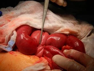 Chirurgická operace uvolnění střevního zauzlení během otevřené abdominální chirurgie.