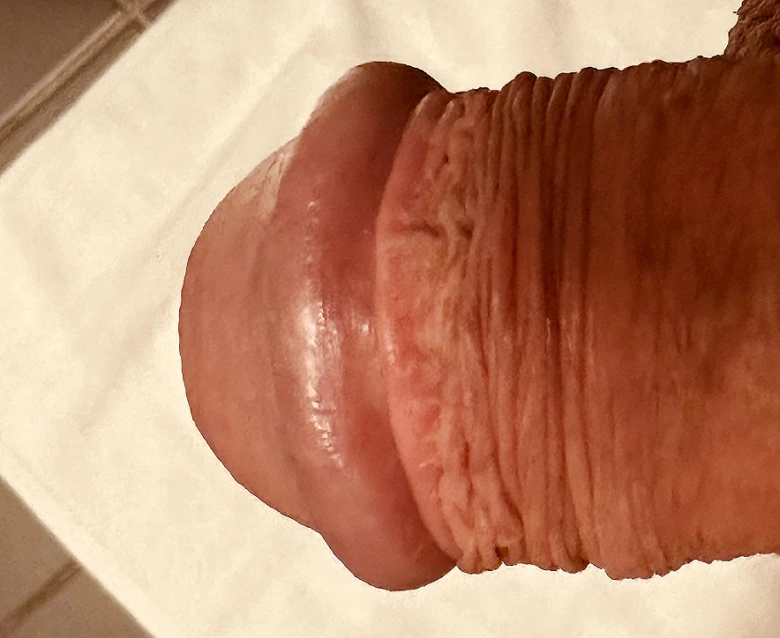 Penis s normální kůží bez viditelné vyrážky nebo pupínků.