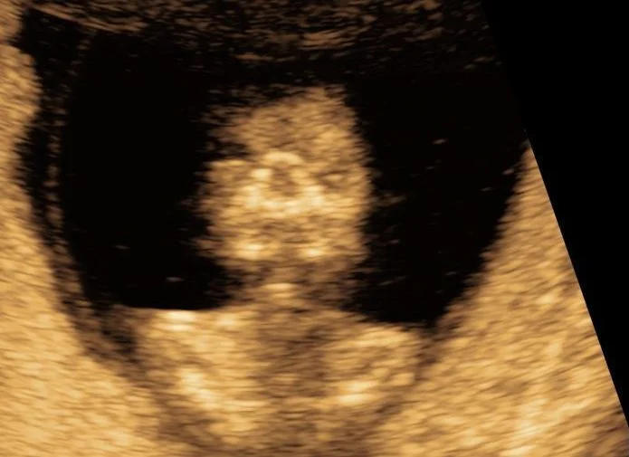 Fetal ultrasound scan