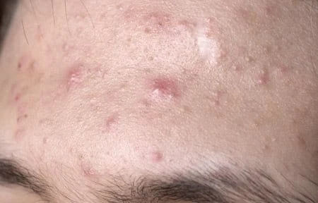 Acne on forehead skin