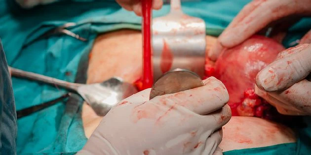 Hysterectomy surgery scene