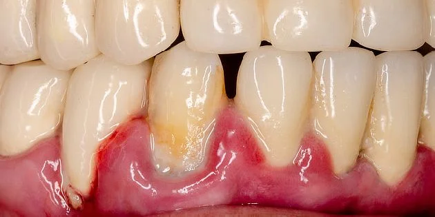 Inflamed gums with bleeding