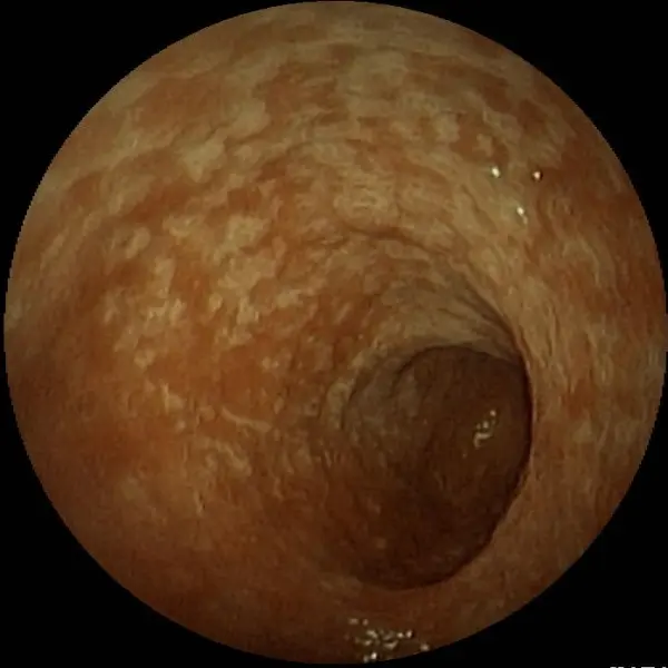 Chronic gastritis endoscopy view