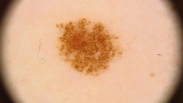 Přiblížený pohled na bronzové znaménko kůže při dermatoskopii.