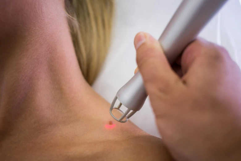 Laserová kontrola znaménka na krku pro prevenci změn.