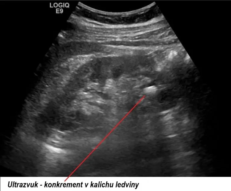 Ultrazvuková snímek ledvinového kamene v kalichu