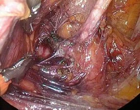 Vnitřní pohled na dělohu během operace odstranění fibroidů.