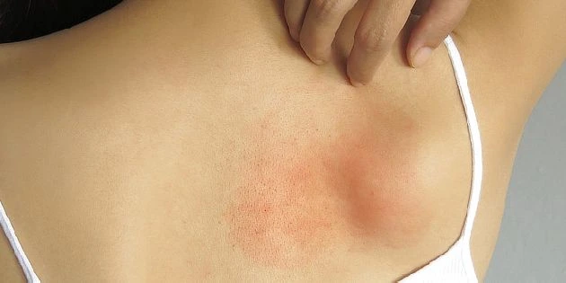 Červená alergická vyrážka na zádech osoby.